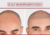 How is Scalp Micropigmentation Treatment Beneficial for Hair Loss? scalp micropigmentation- How is Scalp Micropigmentation Treatment Beneficial for Hair Loss?