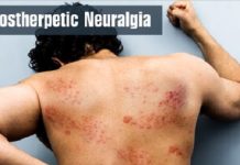 KNOW ABOUT POSTHERPETIC NEURALGIA IN A NUTSHELL