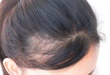 Female Hair Transplantation Benefits, Side Effects
