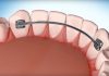 Fixed Retainer