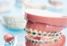 The Best And Worst Colors For Braces