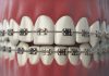 Enhance Your Smile With Invisalign Dental Braces Dental Braces in Dubai
